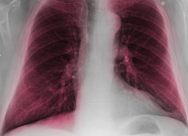 An x-ray of a smoker's lungs