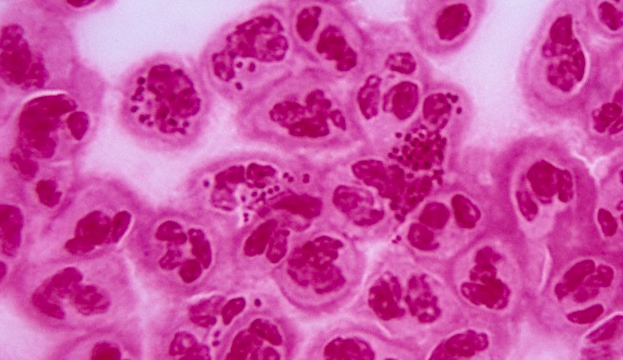 Microscopic gonorrhea cells