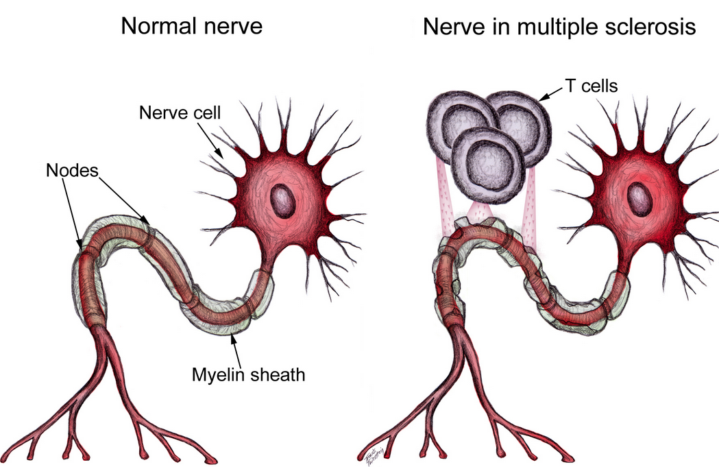 Multiple Sclerosis