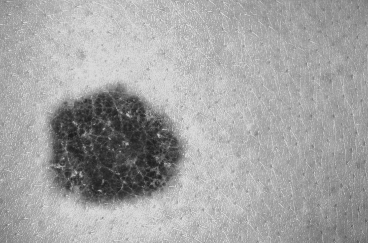 mole melanoma