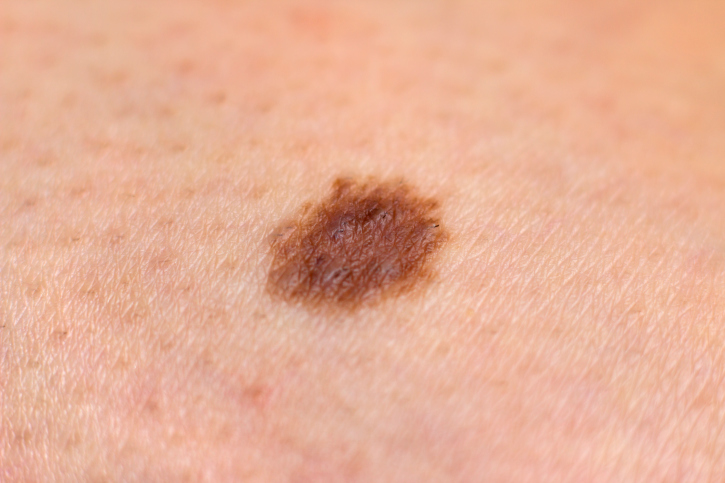 skin mole