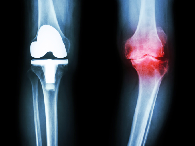 osteoarthritis knee