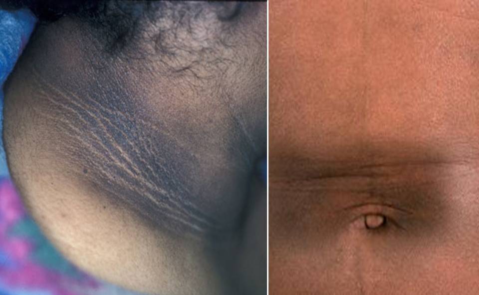 home remedies for hyperpigmentation