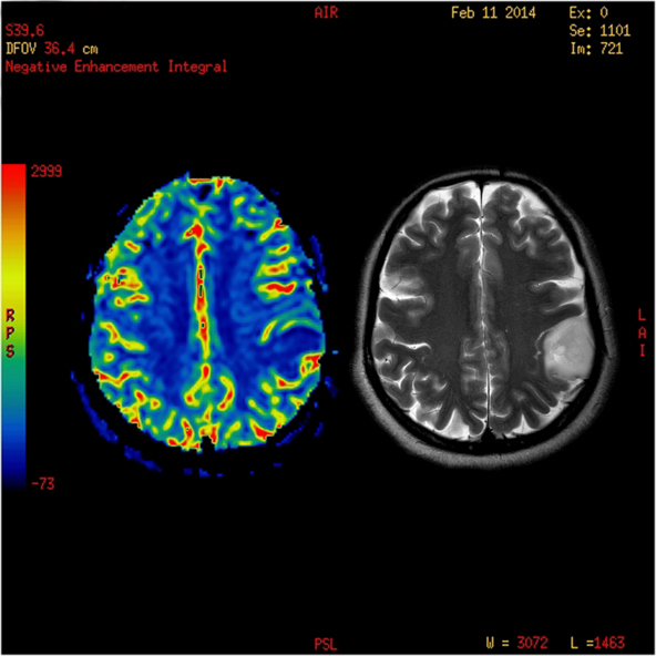 Perfusion MRI imaging of a benign brain tumor