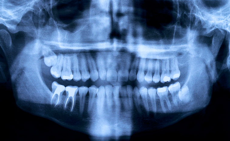 jaw xray