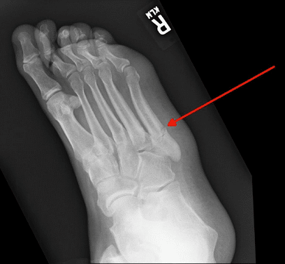Jones fracture 1