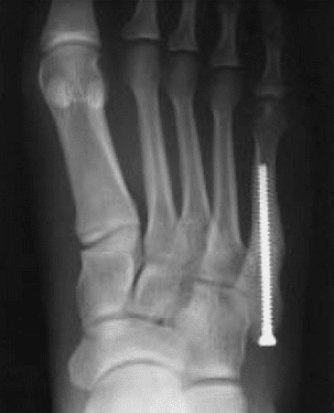 Jones fracture surgery