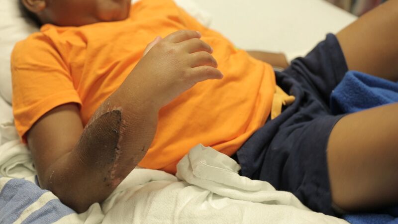 Four Years After World's First Double Hand Transplant: 