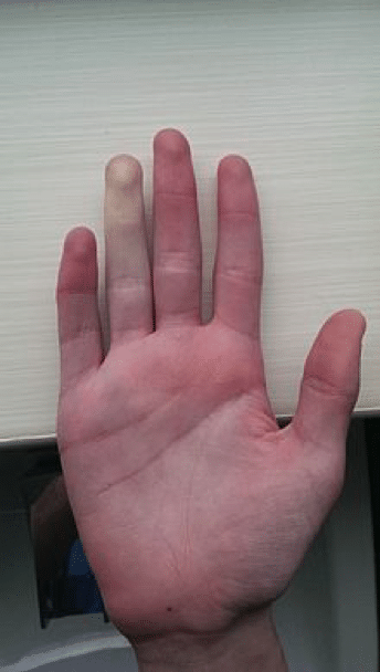 Raynaud's phenomenon hand scleroderma