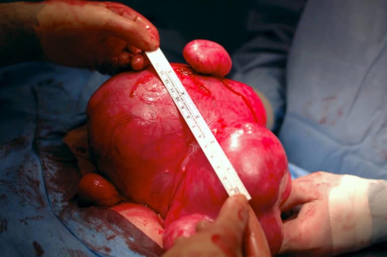 Fibroids Treatment