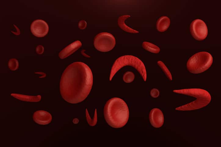 sickle cell red blood cells
