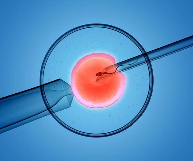 In Vitro Fertilization