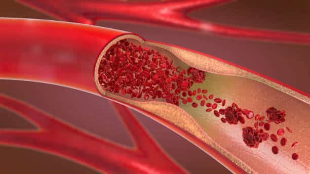 atherosclerosis