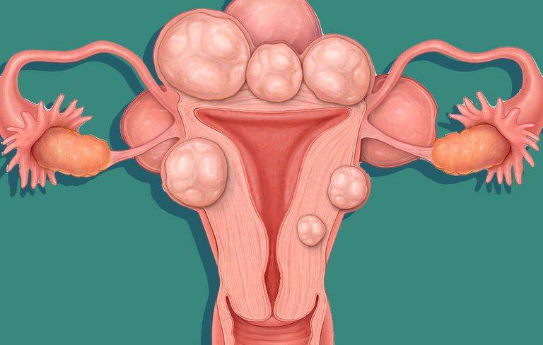 how to shrink fibroids naturally