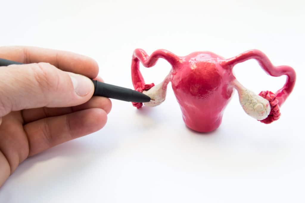 Ovarian Cyst Rupture