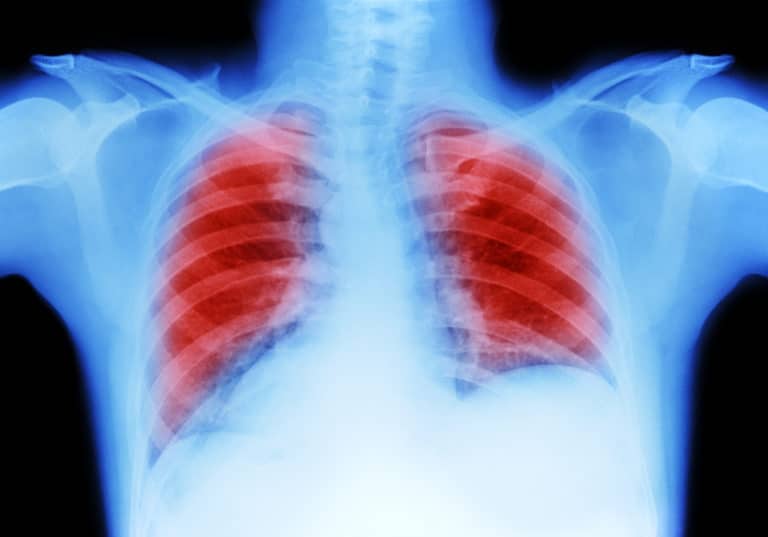 how to get rid of mucus in lungs fast