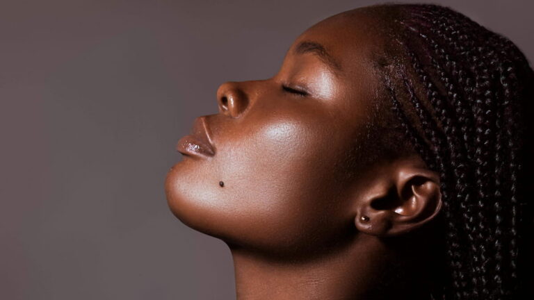 hyperpigmentation