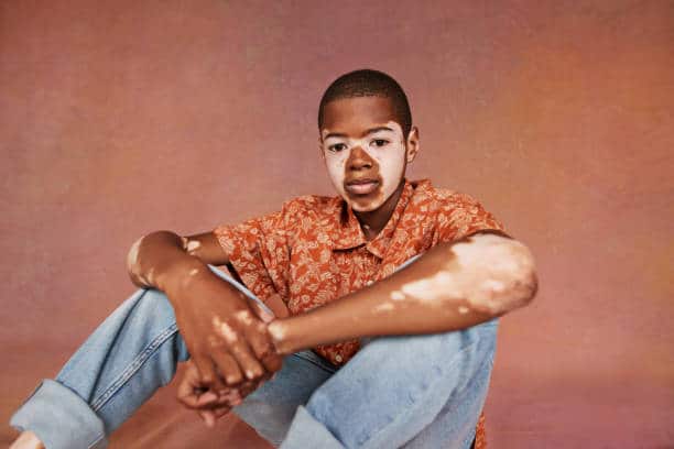 vitiligo