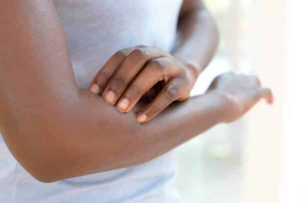 how to get rid of hives