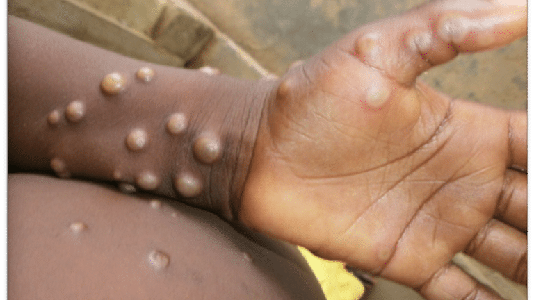 what is monkeypox