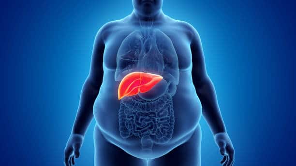 fatty liver disease