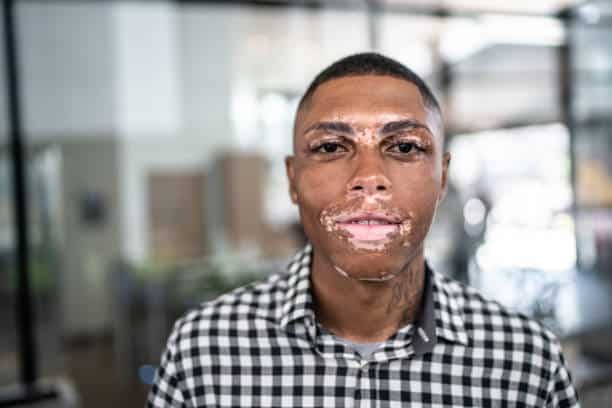 vitiligo