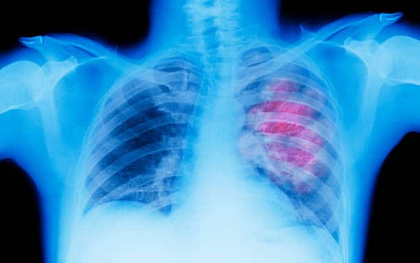 lung disease