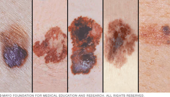 melanoma symptoms pictures
