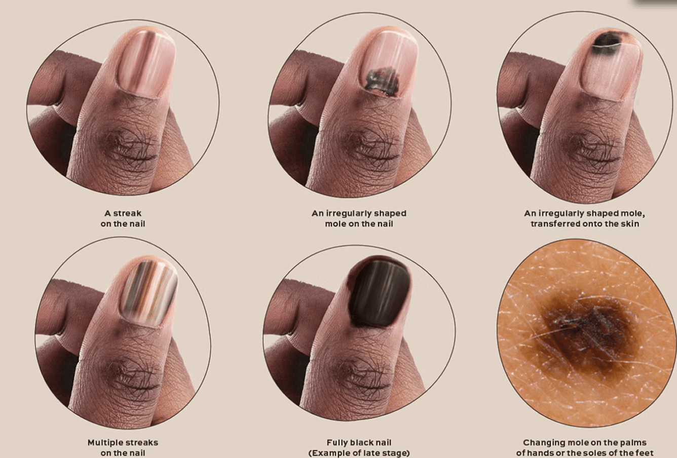 fingernail melanoma symptoms