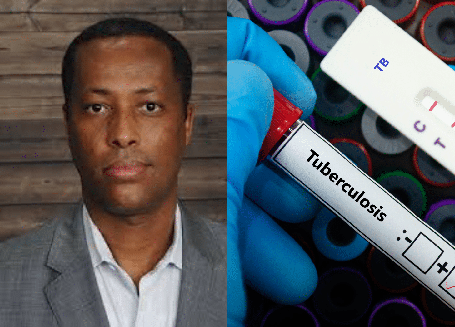 A Black Researcher Is Testing A Late-Stage Tuberculosis Vaccine