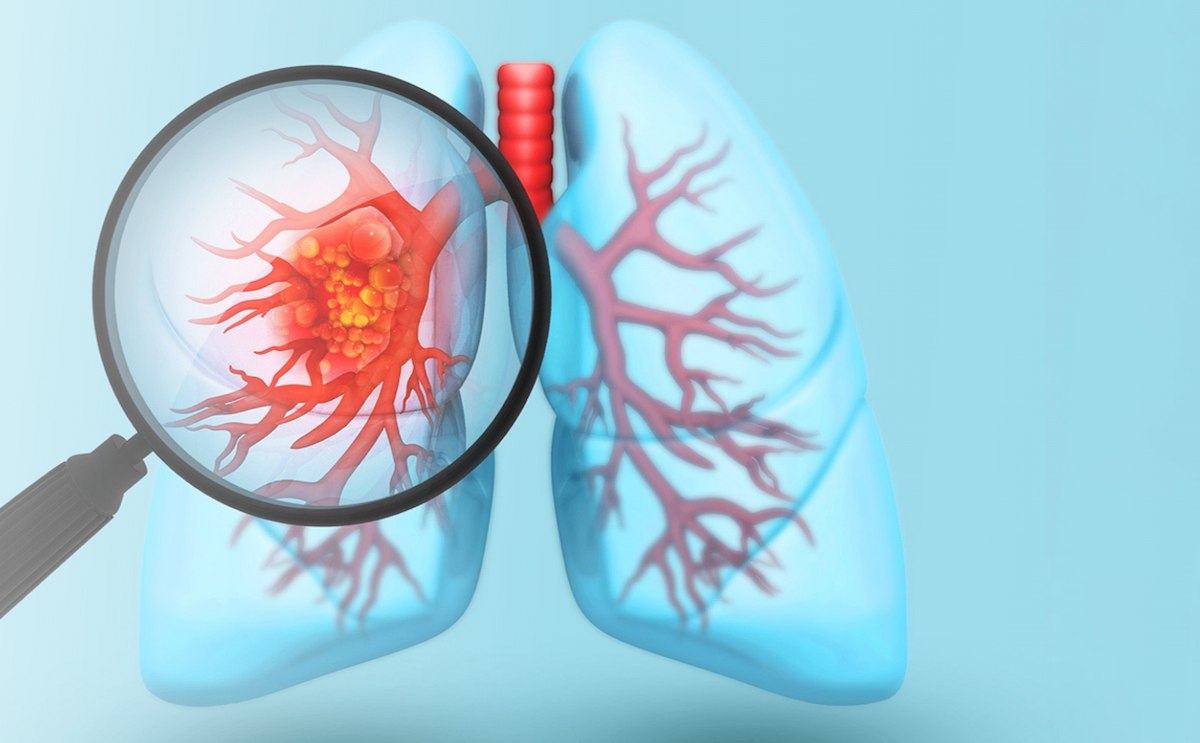 Diagnosed with Advanced Small Cell Lung Cancer? Learn more about a new study for patients with ES-SCLC.