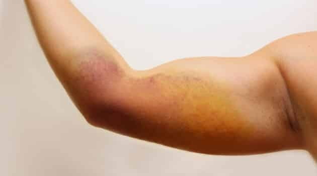 symptoms of blood clot in leg