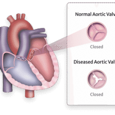 leaky heart valve