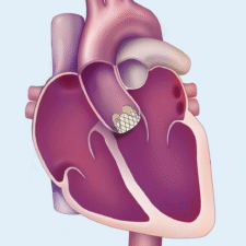 leaky heart valve