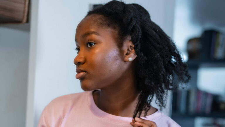 lupus hair loss