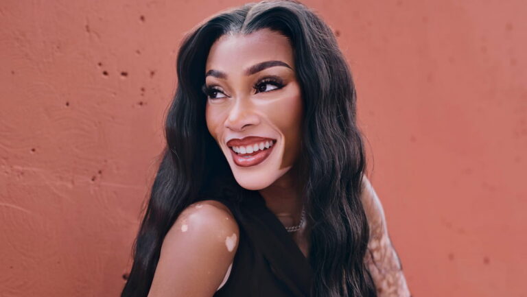Winnie Harlow