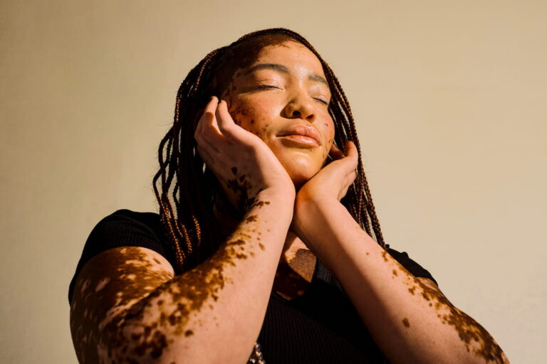 summer style guide, vitiligo